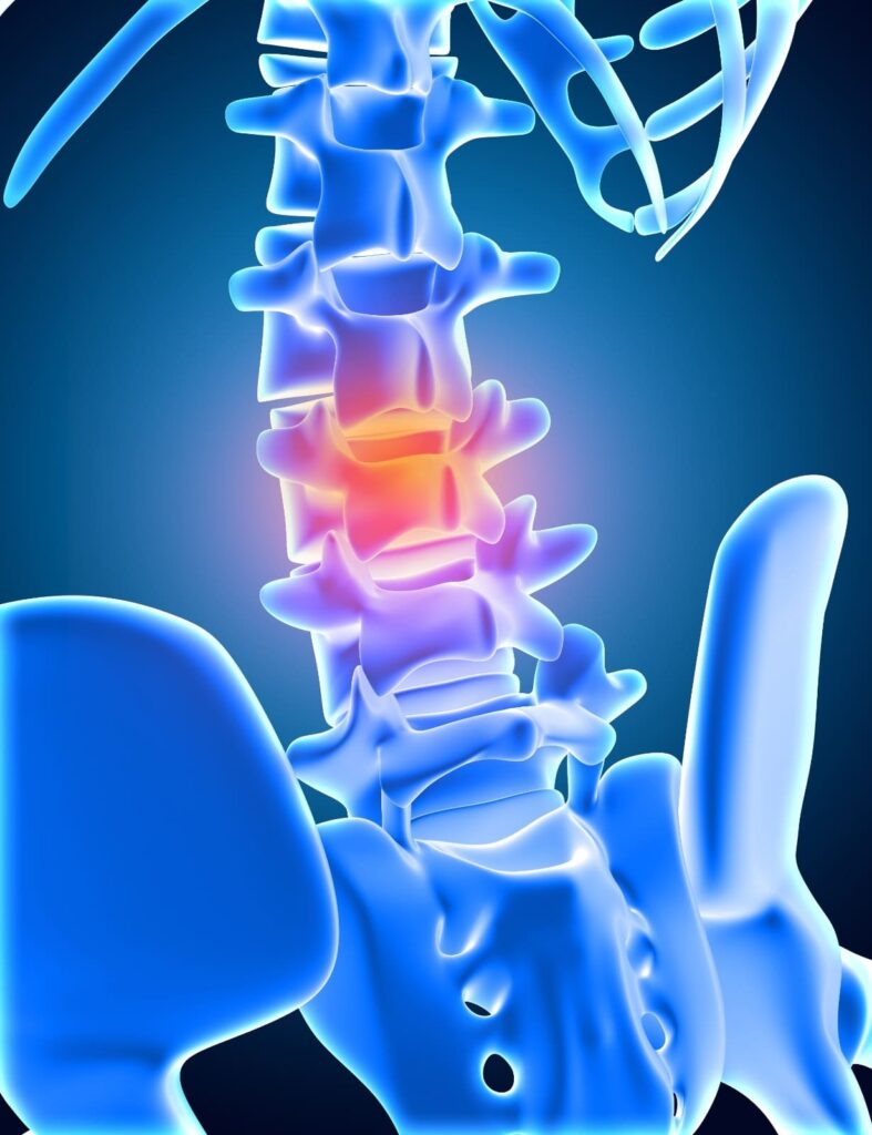espondiloartrose